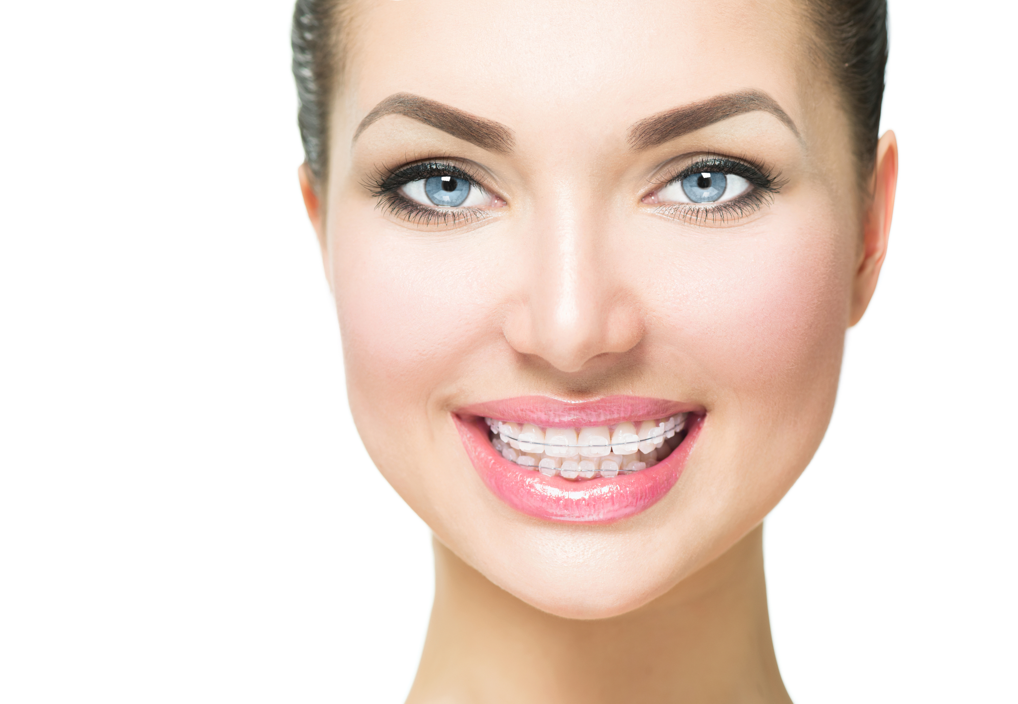 Aparat dentar safir aproape invizibil montat la Clinica DENTORA
