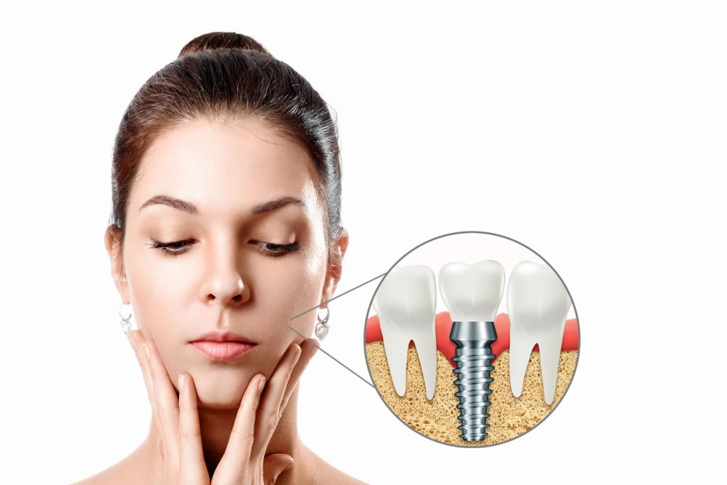 Recuperare după implant dentar la Clinica DENTORA în Chiajna – control postoperator