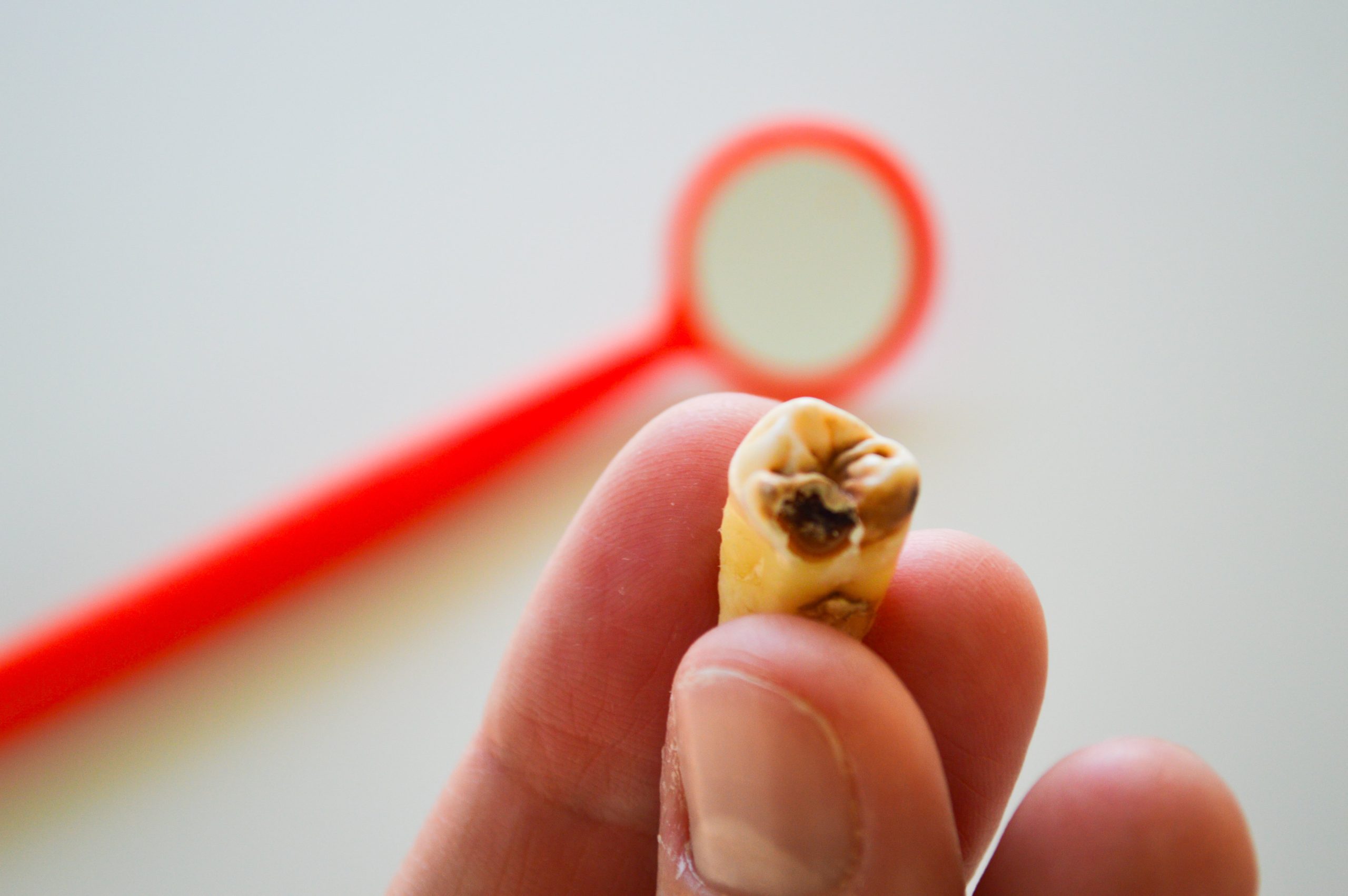 Caria dentară netratată care poate duce la pierderea dintelui