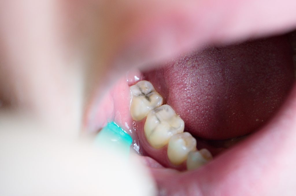 Caria dentară observată în timpul controlului stomatologic la Clinica DENTORA Chiajna