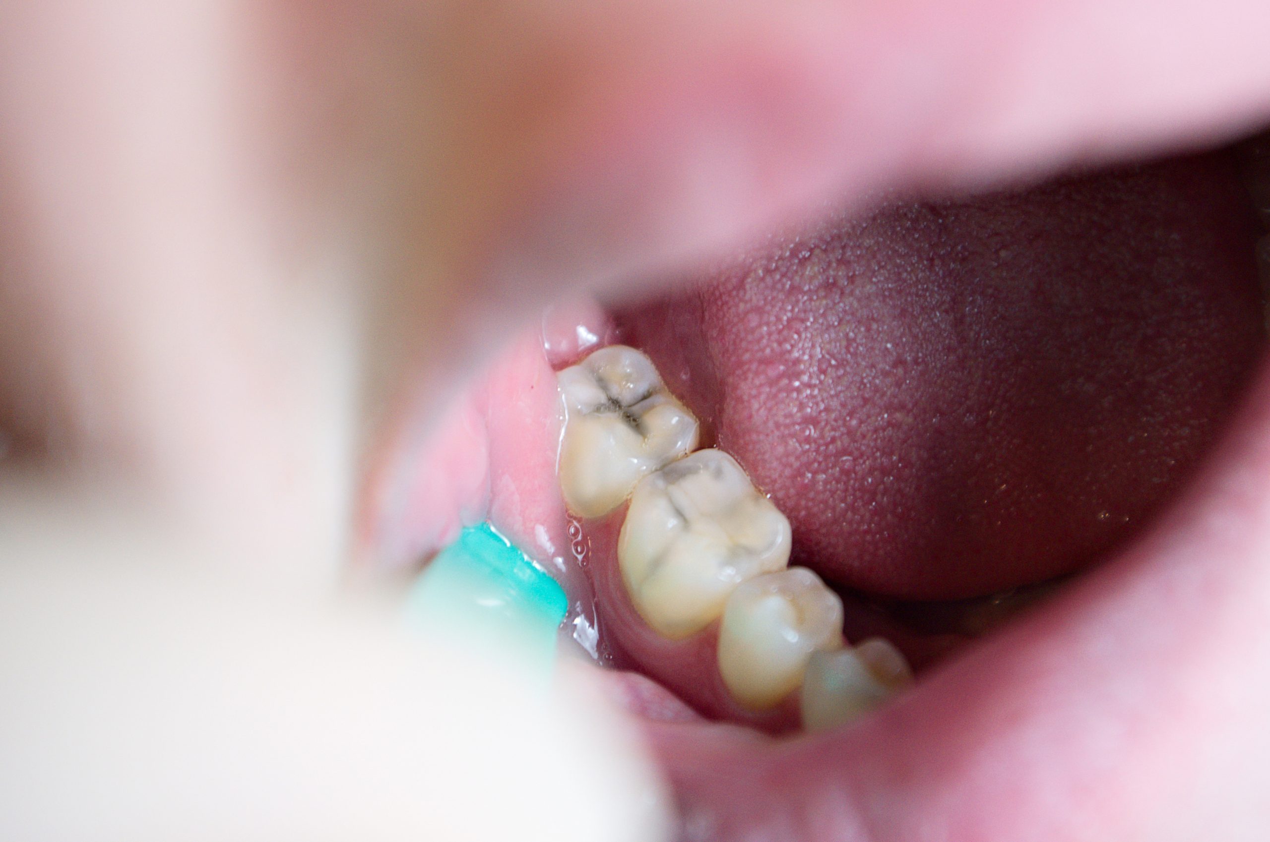 Caria dentară observată în timpul controlului stomatologic la Clinica DENTORA Chiajna