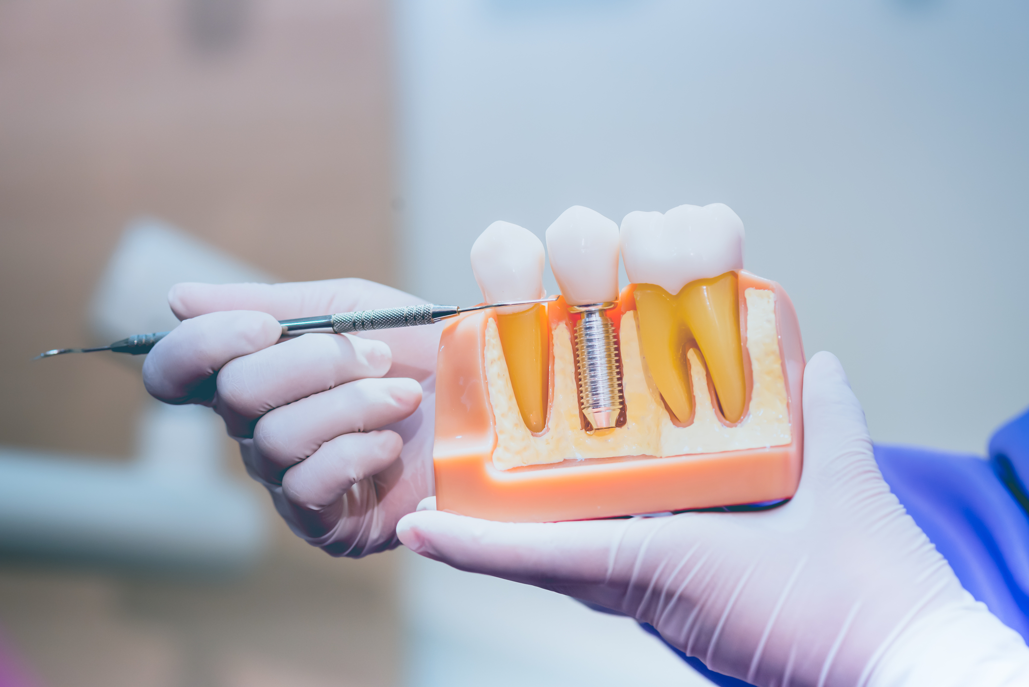implant dentar Megagen Dyos procedura Clinica Dentora București