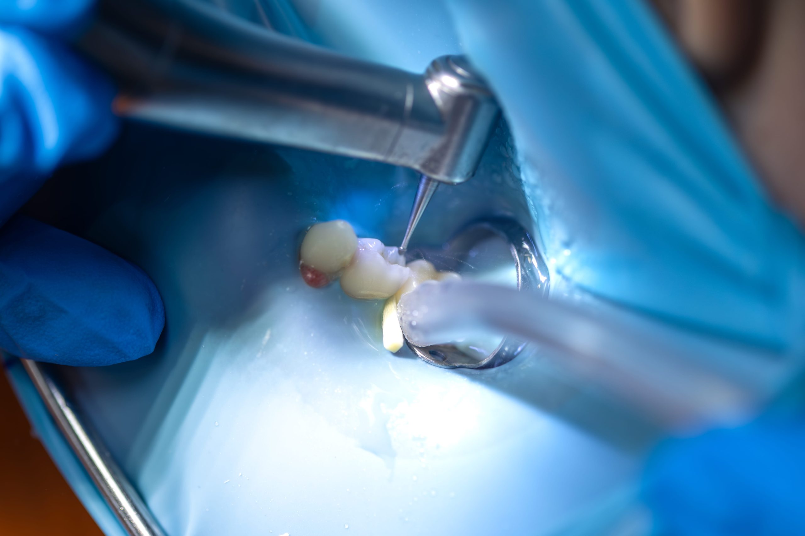 Caria dentară tratată prin plombă dentară la Clinica DENTORA Chiajna